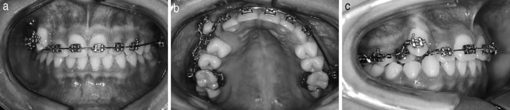 Midline correction and progressive lingual and buccal movement of maxillary right canine and first premolar, respectively, were performed at the 20th month of treatment. Figure 9.
