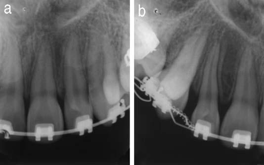 buccal aspect in relation to the first premolar. A panoramic radiographic examination revealed that transposition affected the crown and root.
