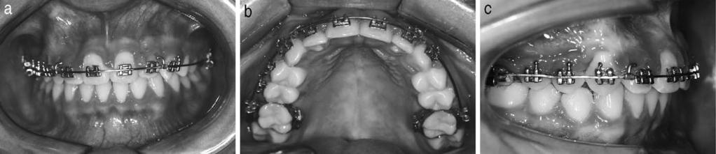 Treatment was initiated by banding of permanent maxillary first molars with a triple tube on the buccal aspect and a lingual tube for placement of a removable transpalatal arch.