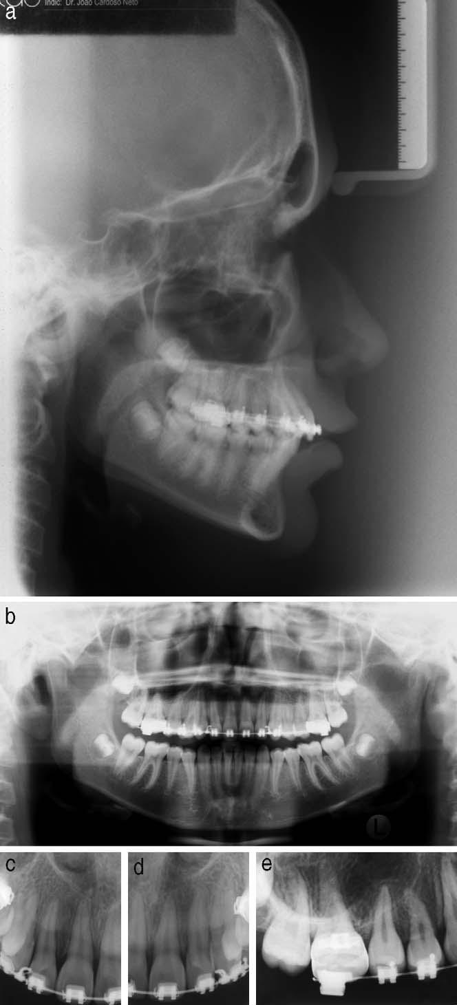 172 CAPELOZZA FILHO, ALMEIDA CARDOSO, AN, BERTOZ Figure 11. The final radiographs show the correction of the transposition, with correct position of canine and first premolar roots.