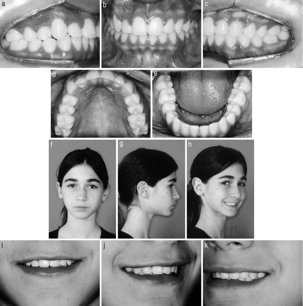 174 CAPELOZZA FILHO, ALMEIDA CARDOSO, AN, BERTOZ Figure 13. Intraoral (a e) and extraoral (f k) photographs 2 months after appliance removal. The regression of gingival hyperplasia could be observed.