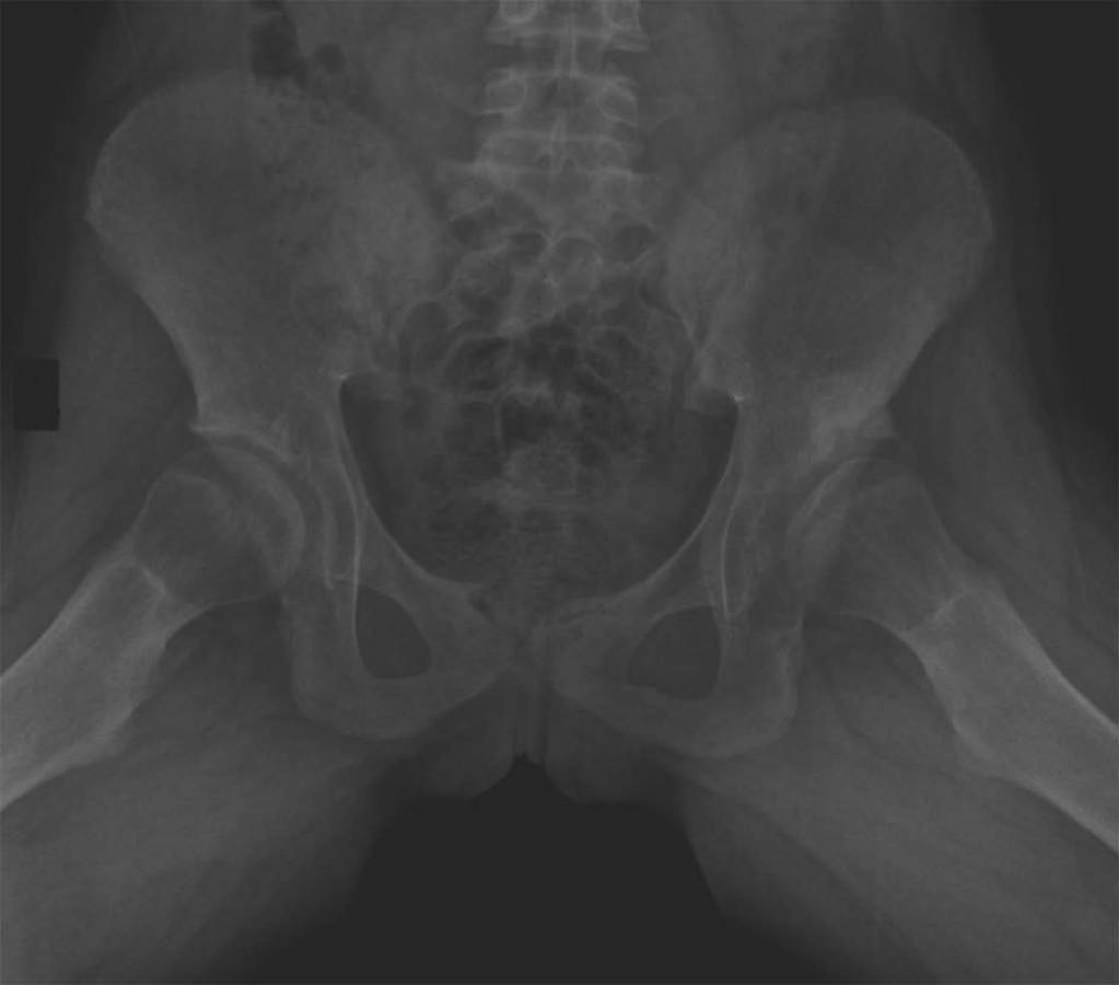 A B R R C D F L Figure 5 Female patient with developmental dysplasia of the hip that was diagnosed in early adolescence.