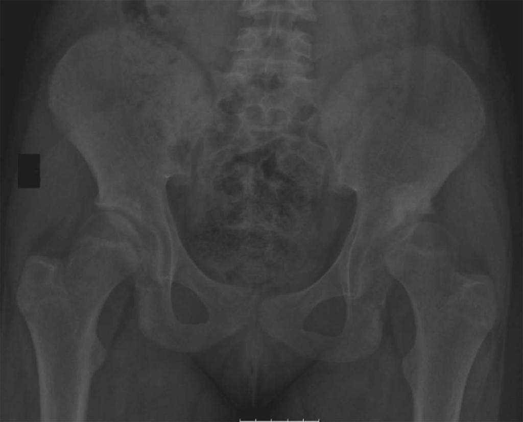 the authors concluded that infants who normalize after treatment with Pavlik harness or spontaneously can benefit from a single-view AP radiograph of the pelvis at the age 6 and 12 mo.