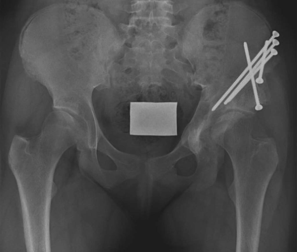 Another study evaluated children with unilateral hip dysplasia for a contralateral hip dysplasia that was not apparent with thorough and recurring evaluations early in childhood.