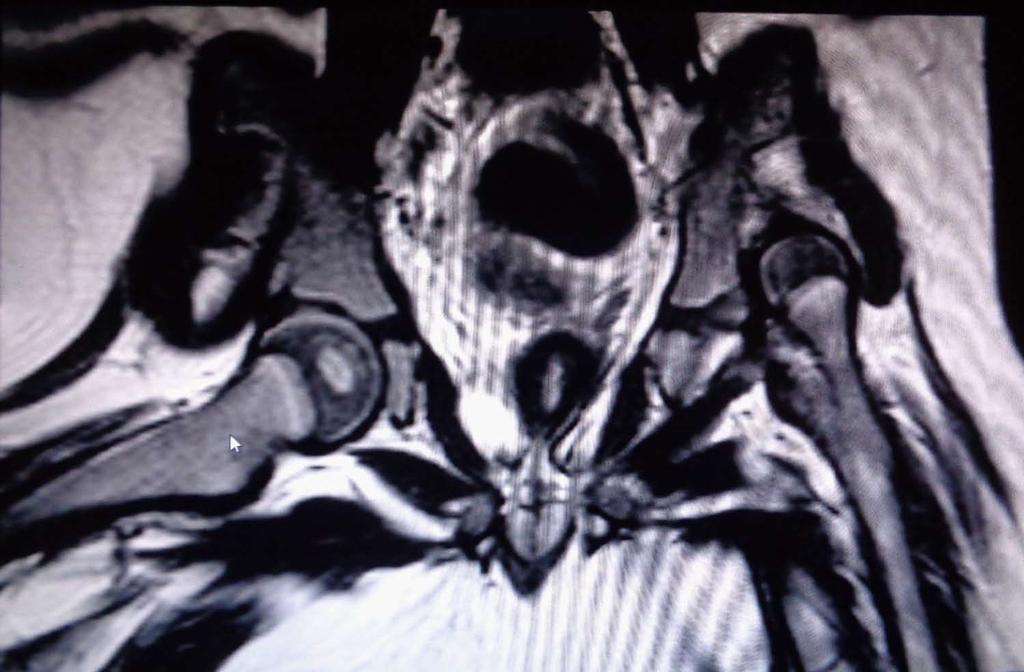 Figure 1 Magnetic resonance imaging of a two-year-old girl with developmental dysplasia of the hip. the age of 4-6 mo. At this stage radiographs become more reliable [5].