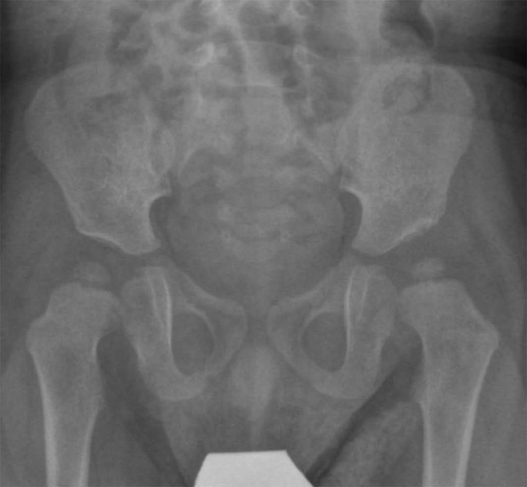 Acetabular index Normal quantitative and consistent definitions for a proper examination and diagnosis, and Graf s method meets all these requirements [69].