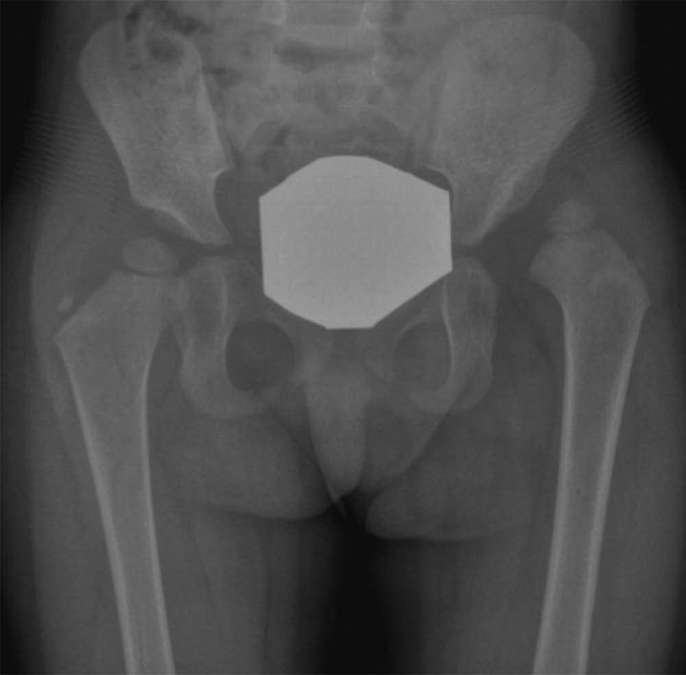Post-operative X-rays after removal of the internal fixation devices are shown; E, F: Due to persistent mild hip dysplasia on the right side, a Salter osteotomy was performed at the age of 4