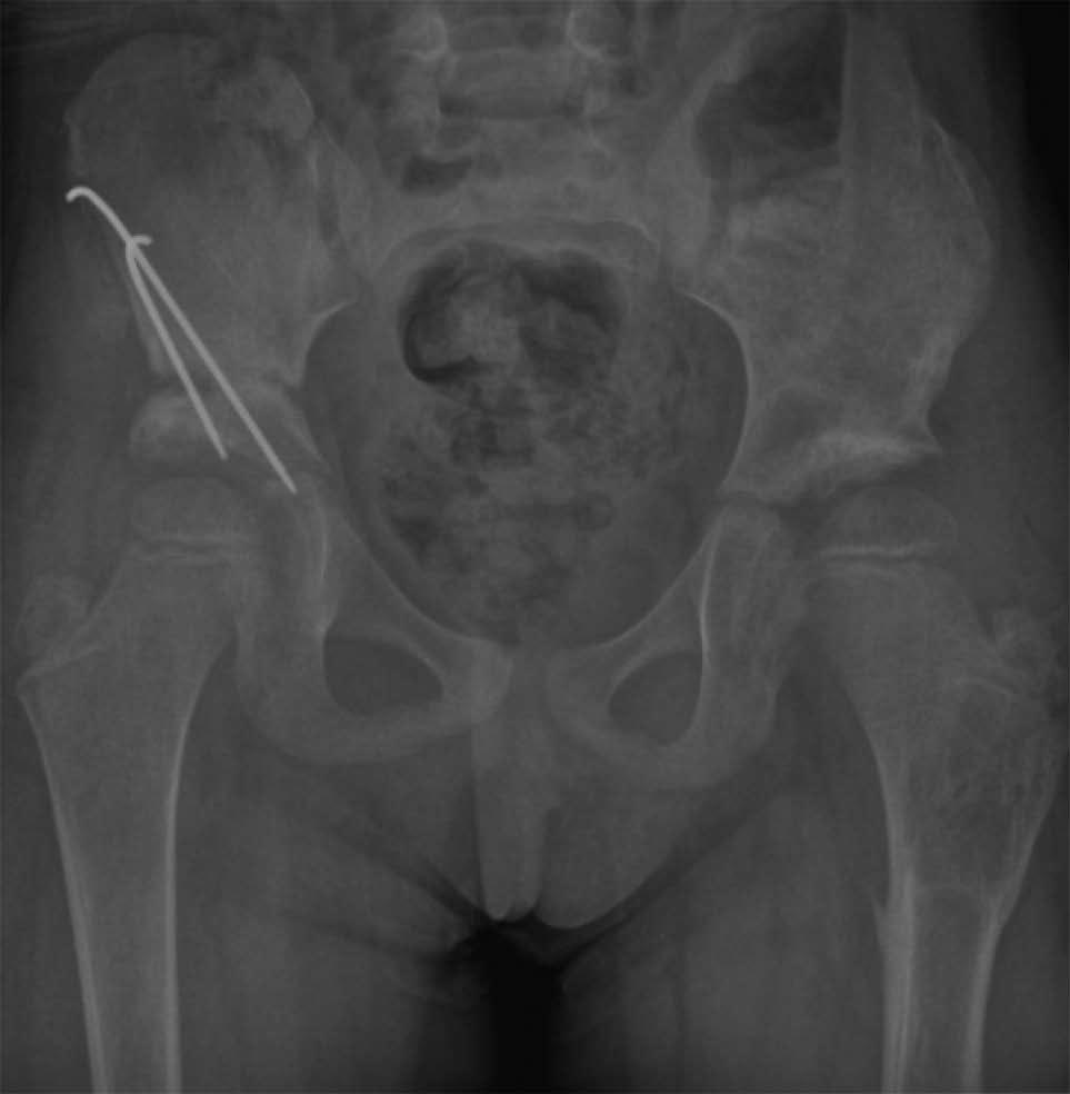 An endoscopic method of performing triple innominate osteotomy has also been developed; although technically demanding, preliminary studies demonstrate good results with reduced surgical