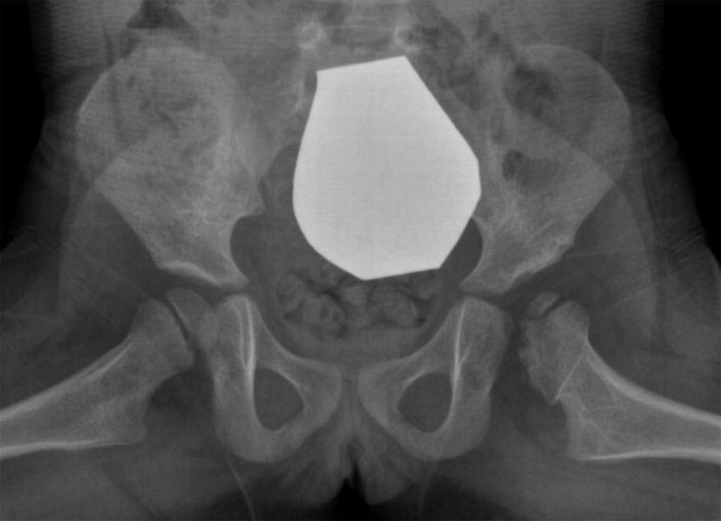 A B C L D E L F Figure 4 Acetabuloplasty. A female patient was diagnosed with DDH of the left hip at the age of 6 mo using sonography. She was treated with a spica cast.