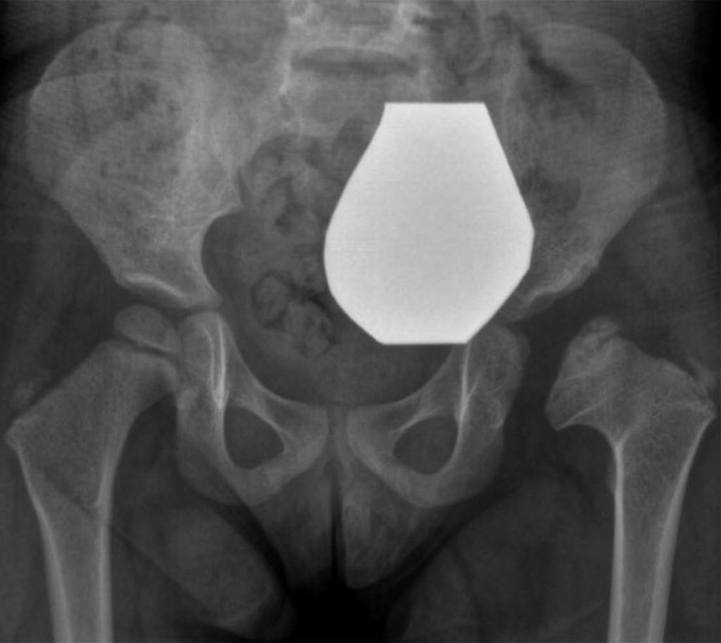 at the age of 5 years; E, F: Follow-up X-rays at the age of 8 years. DDH: Developmental dysplasia of the hip; AVN: Avascular necrosis. dysplasia [158-161].