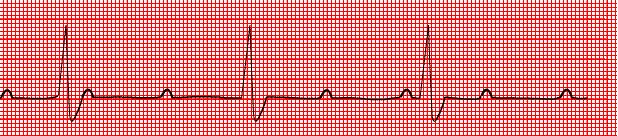 parameters: normal while awake CPAP may reverse the bradyarrhythmias 98 patients with