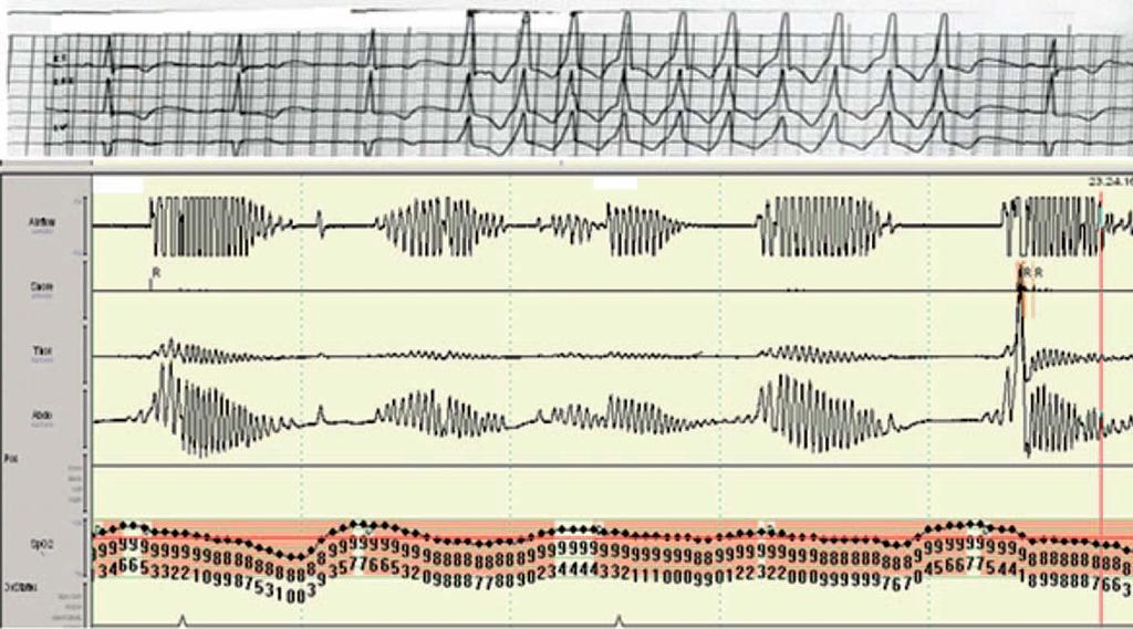 Clinical case 2 Polysomnography AHI : 33/h SO 2 <90%: 18.