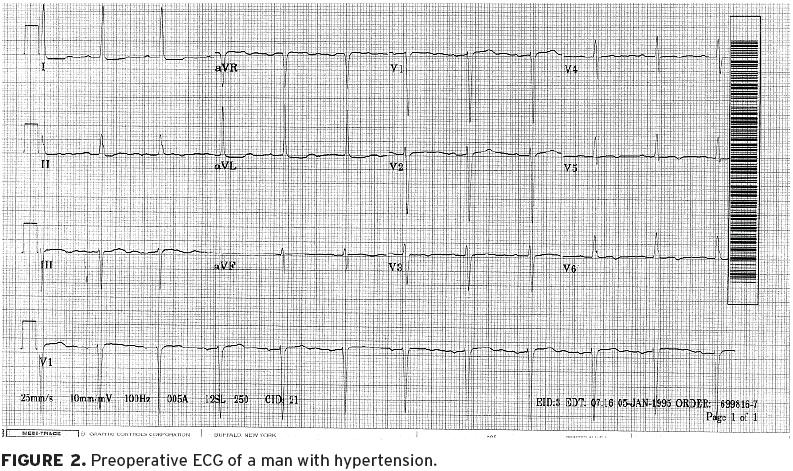 Using the stepwise approach presented in Electrocardiography: Understanding the basics, we need to check the following: (1) Is this ECG regular? Yes, the QRS complexes march out.