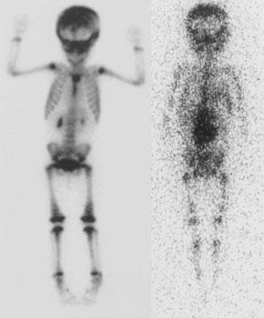 131 I-MIBG (meta-iodobenzylguanine) Neuroblastoma: Bone scan and MIBG exam. Diffuse skeletal metastases are evident on bone scan, but are more clearly revealed on the MIBG exam.