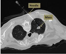 Introduction What is a CT guided lung biopsy? A lung biopsy involves removing small pieces of abnormal lung tissue using a needle.