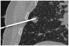 Figure 2 The needle in the abnormal area of lung The radiologist will use the needle to take small samples of lung tissue.