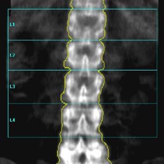 Agreement of Individual Vertebrae Normal Progression and T-Score Variation