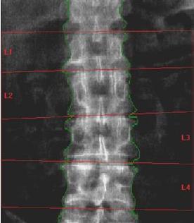 Spine Artifact GI contrast