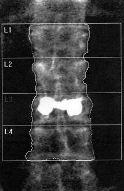 Spine Artifact Vertebral augmentation, L3 Region