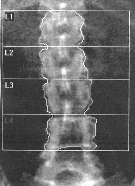 Spine Artifact Laminectomy L4 Region