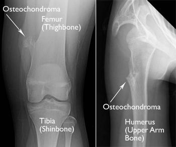 In many cases, solitary osteochondromas do not cause any symptoms, or symptoms may arise long after tumors develop. Osteochondroma is most often diagnosed in patients aged 10 to 30 years.