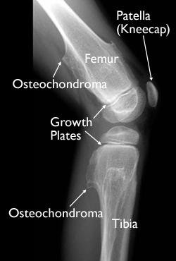 Growth of an osteochondroma after puberty Pain at the site of an osteochondroma A cartilage cap thicker than 2 cm If cancer is suspected, you will need a thorough evaluation that includes MRI and CT