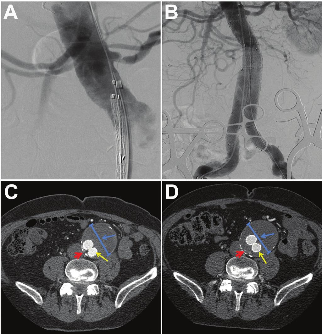 Figure 2. Composite aortograms and computed tomography angiographic (CTA) views of the abdominal aorta of a 79-yearold man with several vascular disease risk factors.