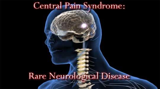 Central Pain Not the result of dystonia or musculoskeletal problems Described as