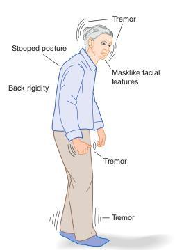 1. Musculoskeletal Problems Rigidity