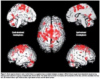 Deleterious effect of contralesional activations: in patients recovering from ischaemic stroke (Calautti et