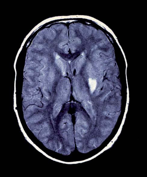 Exploring recovery from Stroke Brain Plasticity exists in stroke recovering patients Can it be