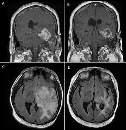 ASCO Update Phase 2 Glioblastoma First demonstration of an