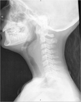 Figures Figure 1 Figure 1 Lateral cervical spine X-ray depicts convex bowing of the air column at the level of the