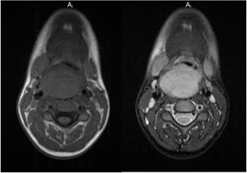 Figure 2 Figure 2 Axial mid-cervical FSE MR images, T1-weighted (left) and T2-weighted (right).