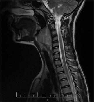 Sagittal cervical FSE T1WI. The oval retropharyngeal mass was intermediate SI in T1WI. It presented with regular borders and showed no signs of invasion of the cervical spine.