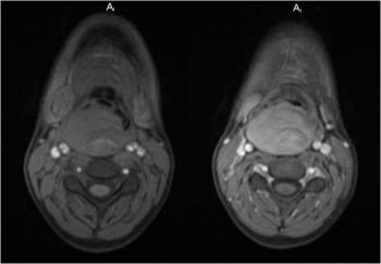 Axial GRE FS T1-weighted pre (left) and post-contrast (right) MR images.