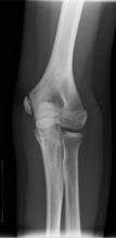 epicondyle +/- swelling Pain with valgus stress Often with flexion contracture