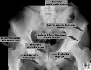 Tender medially Swelling Medial Epicondyle Avulsion Fracture Anatomy Tx : OR