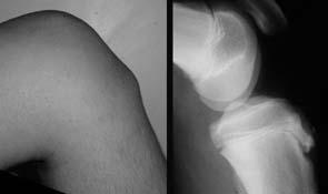 Osgood-Schlatter Common cause of pre- adolescent knee pain Traction apophysitis First described 1891 by Paget 1903- Osgood and Schlatter published separate papers on topic 25% bilateral