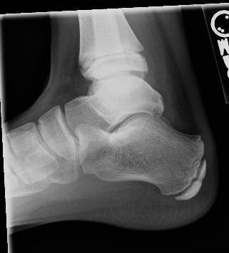 The Heel Sever s The Foot Iselin s Often misdiagnosed as a 5 th metatarsal avulsion fracture Less common form of apophysitis Can be seen commonly in