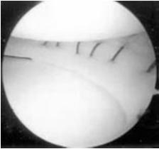 Arthroscopic Partial Meniscectomy BUT not a completely benign procedure Still a progression of degenerative changes compared to untreated knees Does not necessarily correlate with subjective clinical