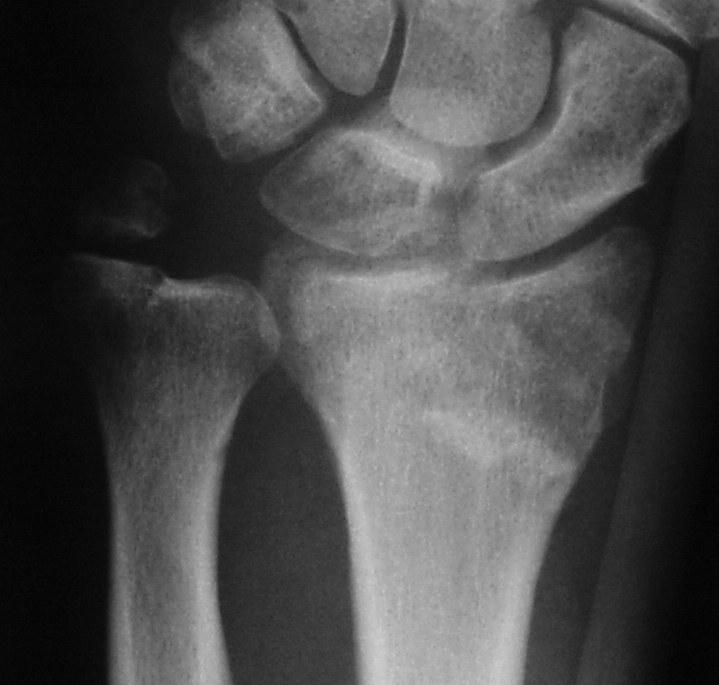Distal Radial Fractures The lifetime risk of sustaining a distal radial fracture is about 16%