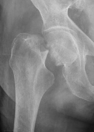 Proximal Femoral Fractures A 50-year-old white woman is estimated