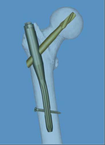 Advances to Treat these Fractures Locking