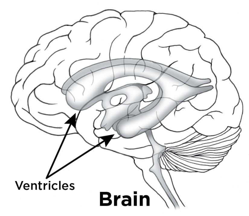 Hydrocephalus is when too much cerebrospinal fluid (CSF) builds up in the ventricles of your child s brain. The ventricles are cavities full of CSF and this fluid is always being made.