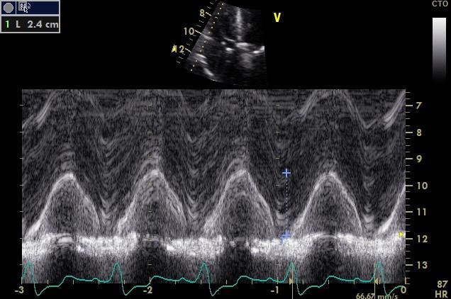 influence TAPSE value due to ventricular interdependence Tissue Doppler