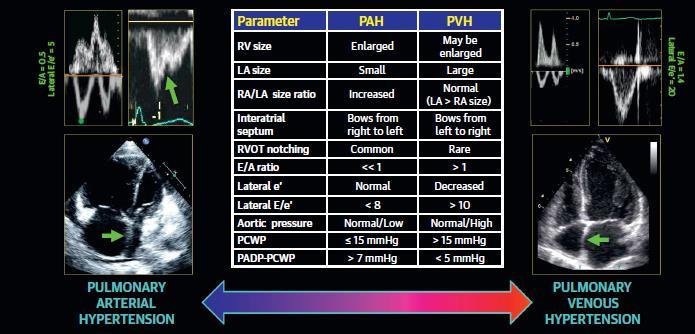 PAH vs PVH: Echocardiographic