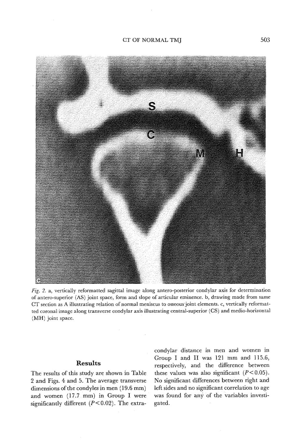 CT OF NORMAL TMJ 503 Fig. 2.