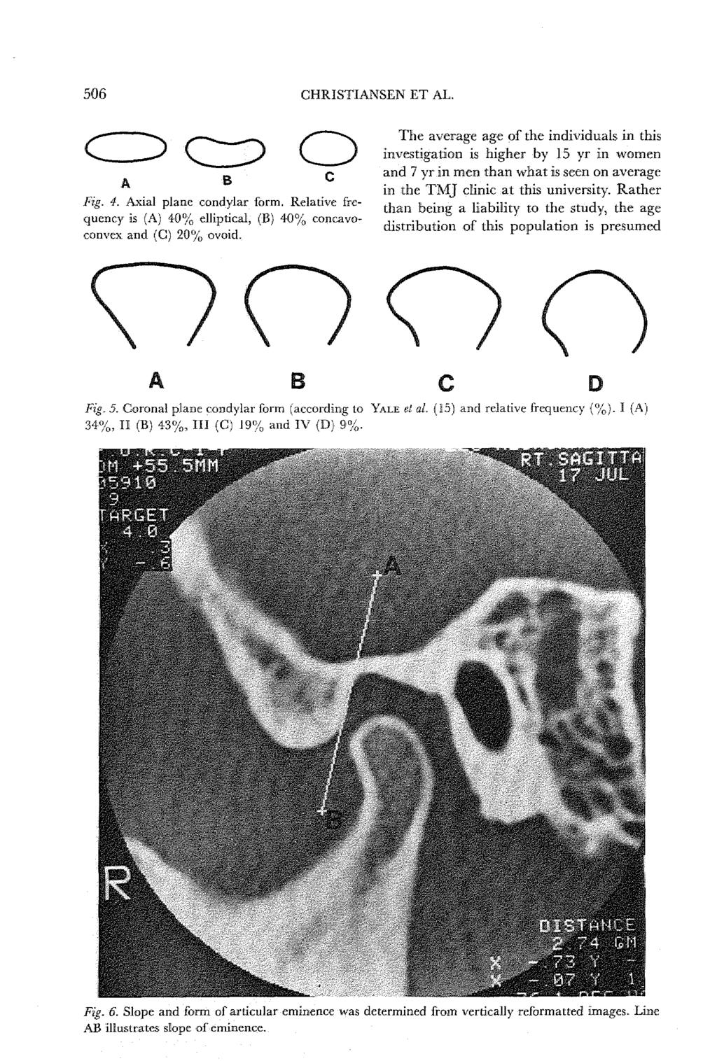 506 CHRISTIANSEN ET AL. o Fig. 4. Axial plane condylar form. Relative frequency is (A) 40% elliptical, (B) 40% concavoconvex and (C) 20%. ovoid.