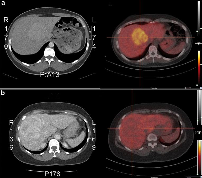 438 Eur J Nucl Med Mol Imaging (2011) 38:436 440 Fig. 1 CT and PET/CT images of a patient with FNH (a) and HCA (b) 15 min after i.v. injection of 150 MBq 18 F-FCH.